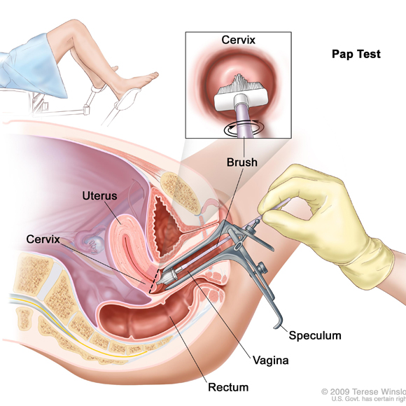 deteccion de cáncer ginecologico