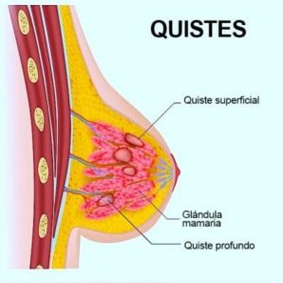 patologia quistes de mama